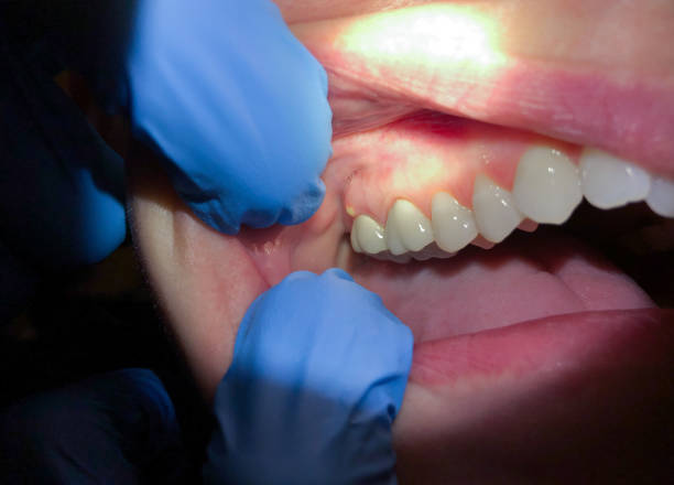 Best Dentist for Tooth Abscess  in Arcanum, OH